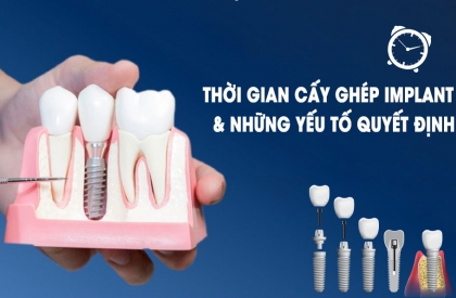 THỜI GIAN CẤY GHÉP IMPLANT VÀ NHỮNG YẾU TỐ QUYẾT ĐỊNH